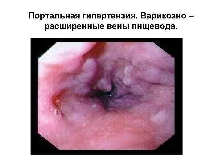 Портальная гипертензия. Варикозно – расширенные вены пищевода. 