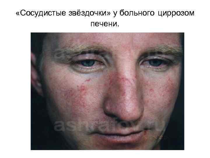  «Сосудистые звёздочки» у больного циррозом печени. 