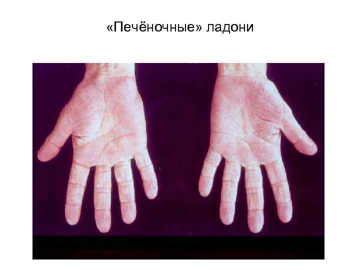  «Печёночные» ладони 