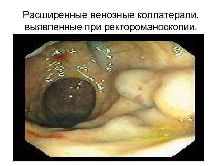 Расширенные венозные коллатерали, выявленные при ректороманоскопии. 