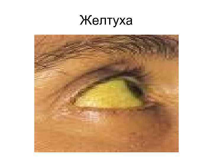 Желтуха 
