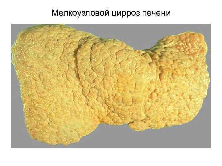 Мелкоузловой цирроз печени 