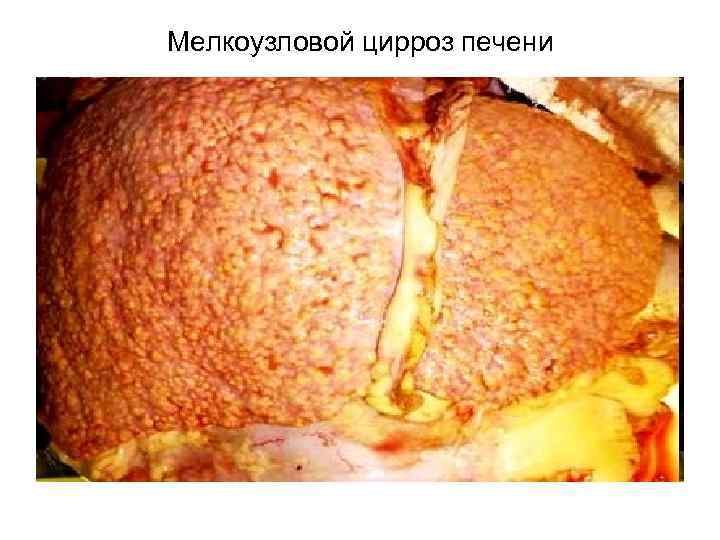 Мелкоузловой цирроз печени 