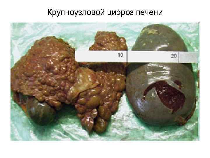 Крупноузловой цирроз печени 