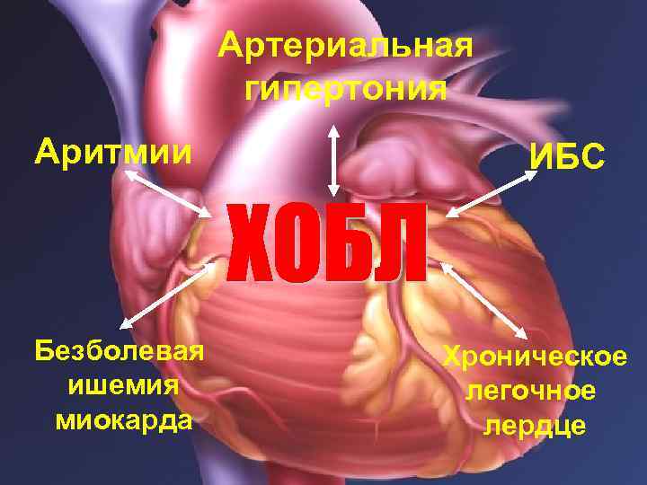 Артериальная гипертония Аритмии Безболевая ишемия миокарда ИБС Хроническое легочное лердце 