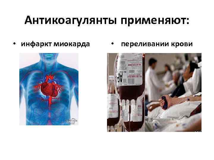 Антикоагулянты применяют: • инфаркт миокарда • переливании крови 