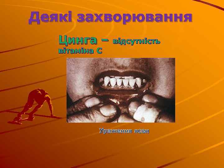 Деякі захворювання Цинга – відсутність вітаміна С Ураження ясен 