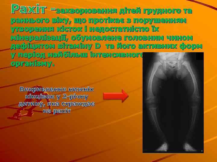 Рахіт -захворювання дітей грудного та раннього віку, що протікає з порушенням утворення кісток і