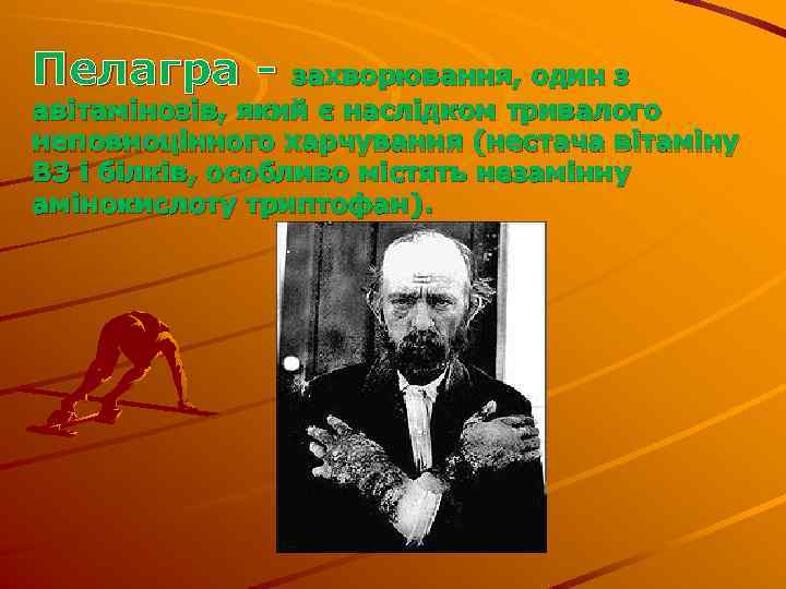 Пелагра - захворювання, один з авітамінозів, який є наслідком тривалого неповноцінного харчування (нестача вітаміну