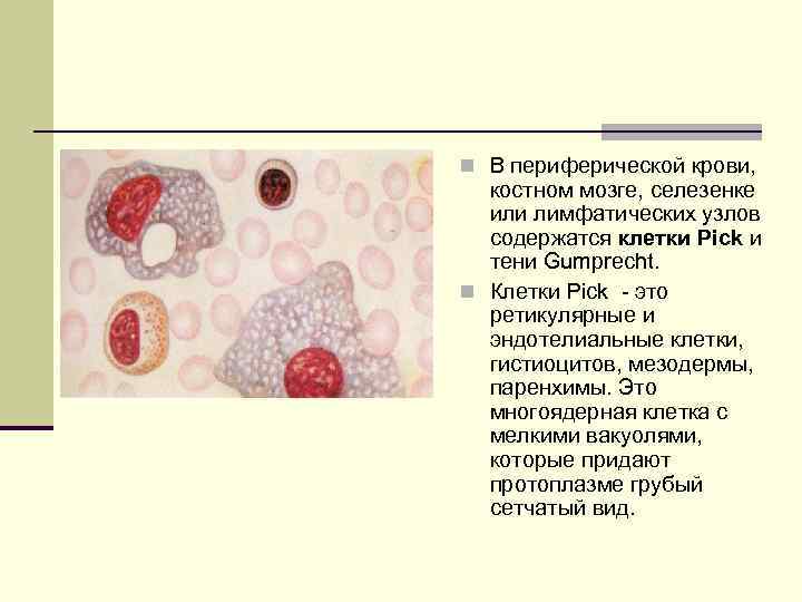 n В периферической крови, костном мозге, селезенке или лимфатических узлов содержатся клетки Pick и