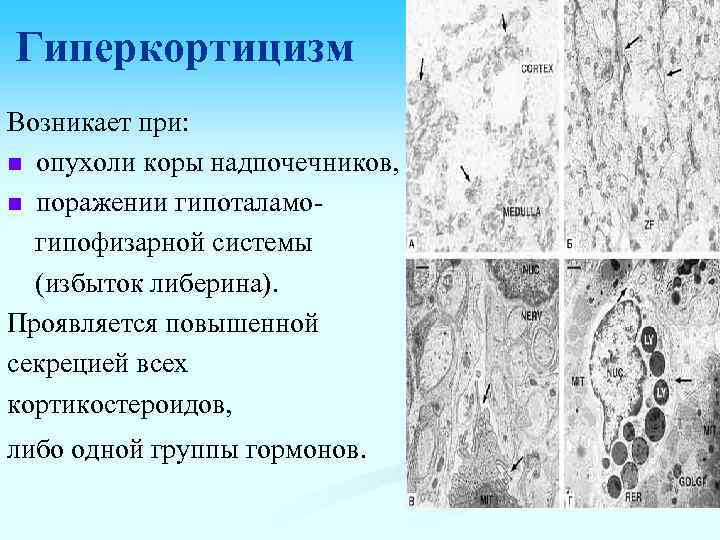Гиперкортицизм Возникает при: n опухоли коры надпочечников, n поражении гипоталамогипофизарной системы (избыток либерина). Проявляется