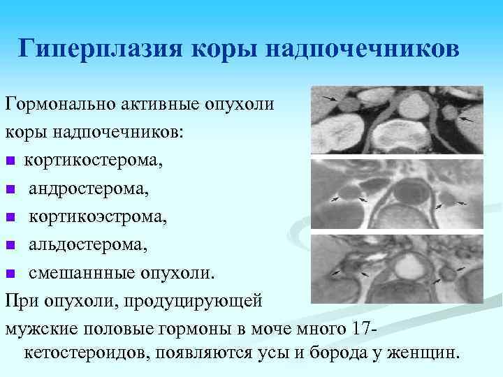 Гиперплазия коры надпочечников Гормонально активные опухоли коры надпочечников: n кортикостерома, n андростерома, n кортикоэстрома,