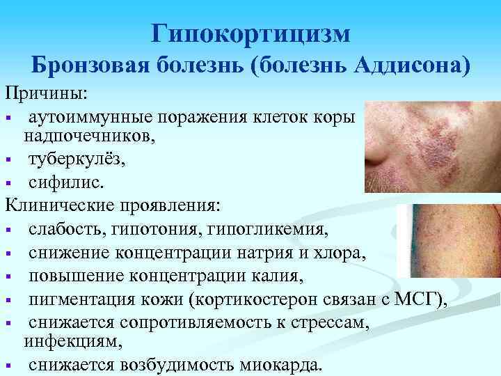 Гипокортицизм Бронзовая болезнь (болезнь Аддисона) Причины: § аутоиммунные поражения клеток коры надпочечников, § туберкулёз,