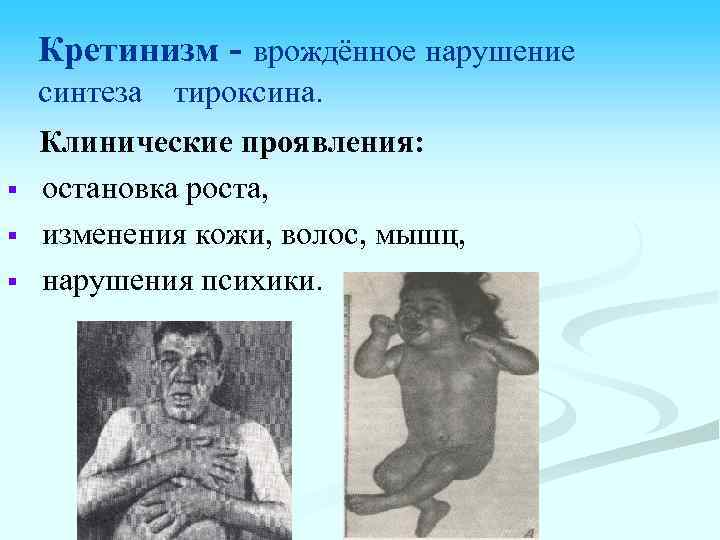 Кретинизм - врождённое нарушение синтеза § § § тироксина. Клинические проявления: остановка роста, изменения