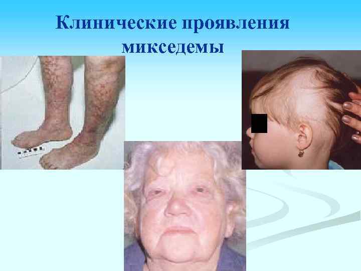 Клинические проявления микседемы 