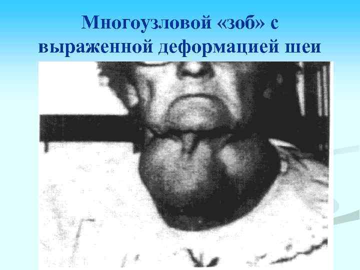 Многоузловой «зоб» с выраженной деформацией шеи 