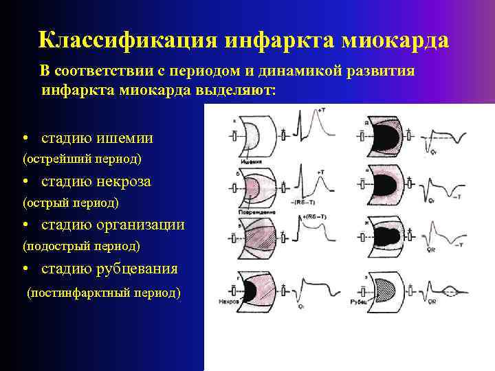 Классификация инфаркта миокарда В соответствии с периодом и динамикой развития инфаркта миокарда выделяют: •