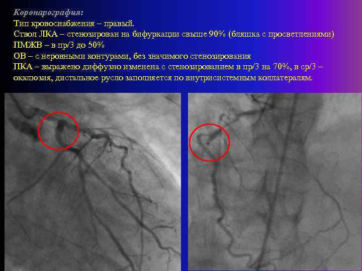 Коронарография: Тип кровоснабжения – правый. Ствол ЛКА – стенозирован на бифуркации свыше 90% (бляшка