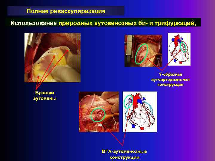 Полная реваскуляризация Использование природных аутовенозных би- и трифуркаций, Y-образная аутоартериальная конструкция Бранши аутовены ВГА-аутовенозные