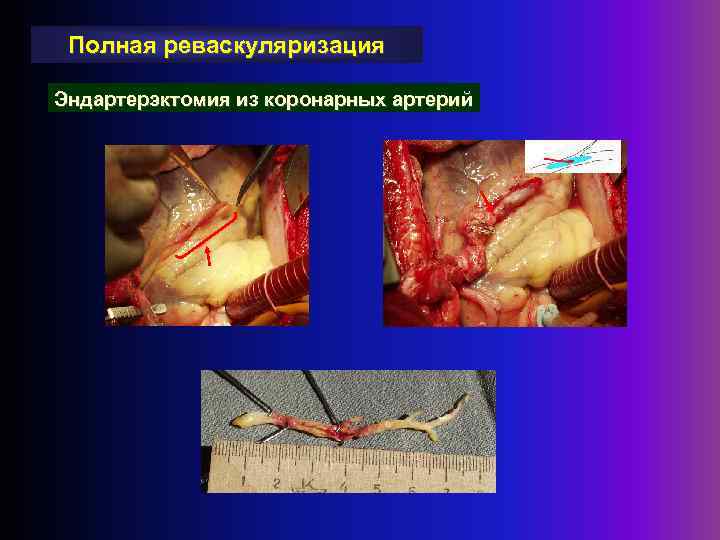Полная реваскуляризация Эндартерэктомия из коронарных артерий 
