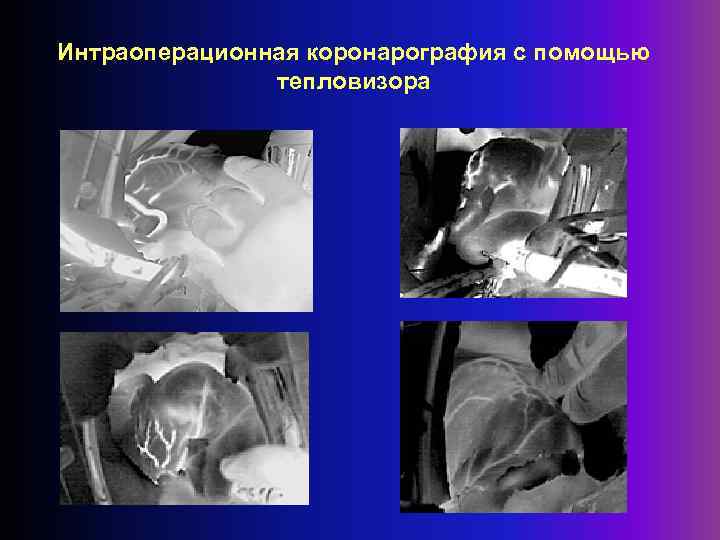 Интраоперационная коронарография с помощью тепловизора 