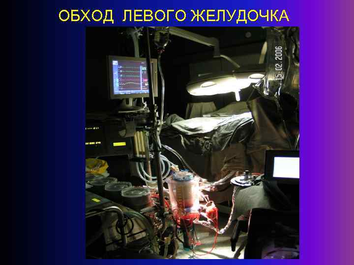 ОБХОД ЛЕВОГО ЖЕЛУДОЧКА 