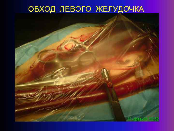 ОБХОД ЛЕВОГО ЖЕЛУДОЧКА 