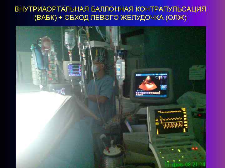 ВНУТРИАОРТАЛЬНАЯ БАЛЛОННАЯ КОНТРАПУЛЬСАЦИЯ (ВАБК) + ОБХОД ЛЕВОГО ЖЕЛУДОЧКА (ОЛЖ) 