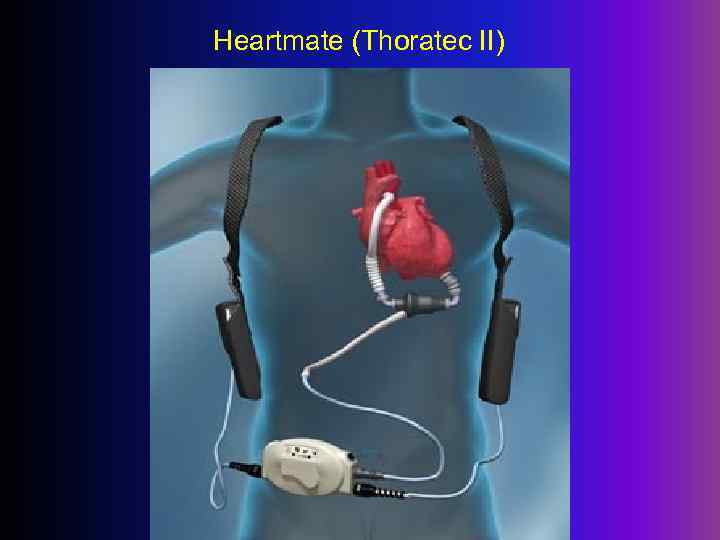 Heartmate (Thoratec II) 