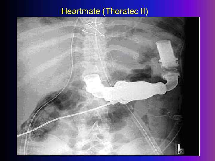 Heartmate (Thoratec II) 