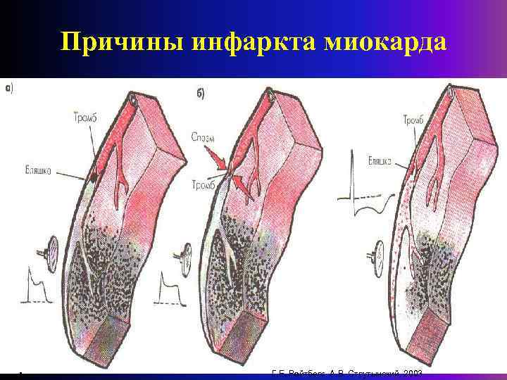 Причины инфаркта миокарда • Г. Е. Ройтберг, А. В. Струтынский. 2003 