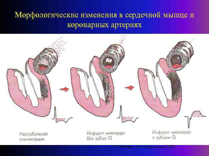 Морфологические изменения в сердечной мышце и коронарных артериях • Г. Е. Ройтберг, А. В.