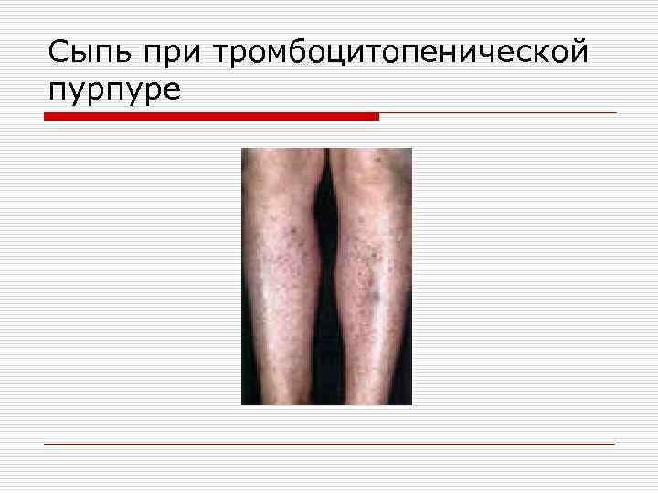 Сыпь при тромбоцитопенической пурпуре 