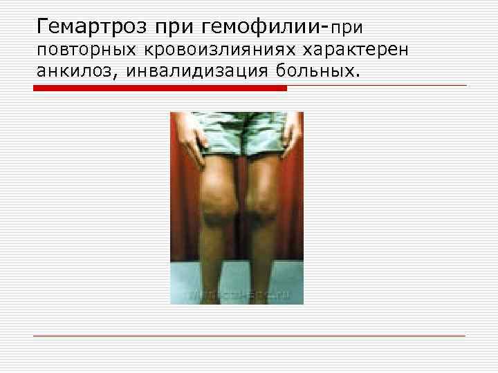 Гемартроз при гемофилии-при повторных кровоизлияниях характерен анкилоз, инвалидизация больных. 