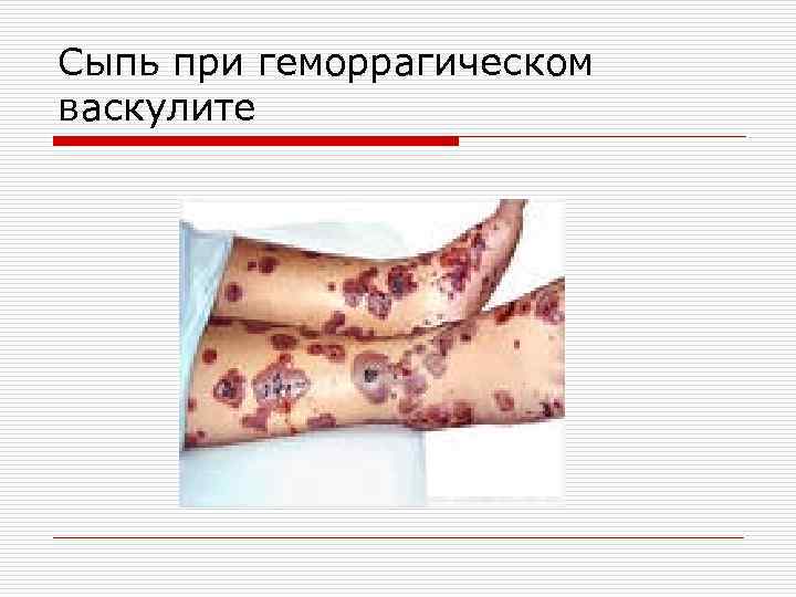 Сыпь при геморрагическом васкулите 