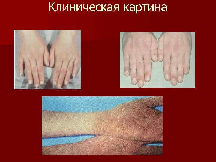 Клиническая картина 