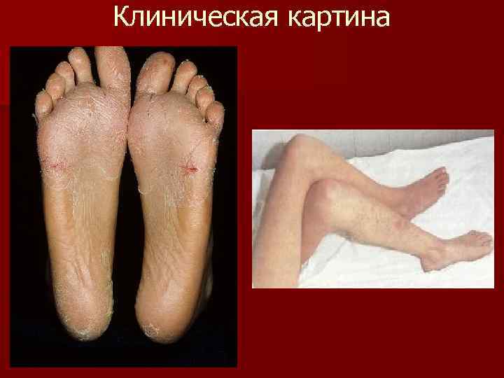 Клиническая картина 