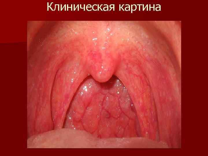 Клиническая картина 