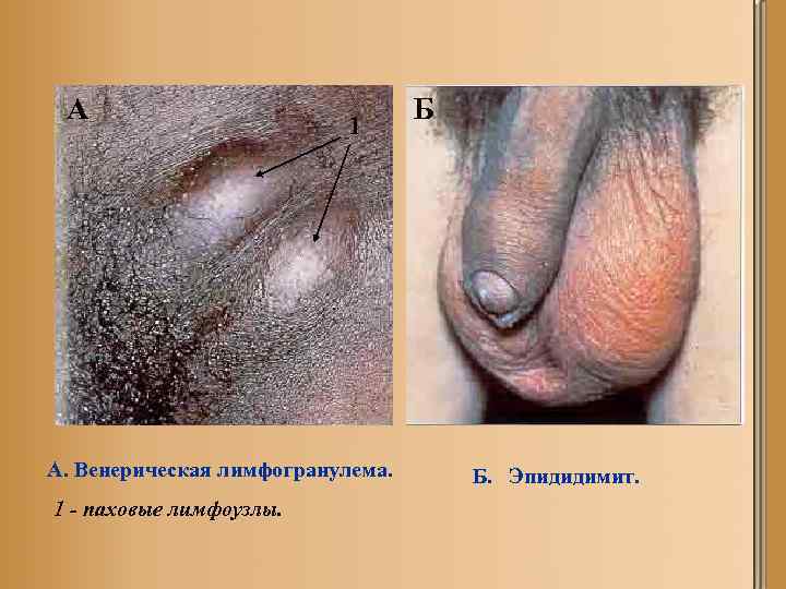 А 1 А. Венерическая лимфогранулема. 1 - паховые лимфоузлы. Б Б. Эпидидимит. 