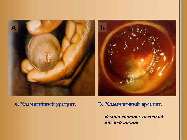 А А. Хламидийный уретрит. Б Б. Хламидийный проктит. Колоноскопия слизистой прямой кишки. 
