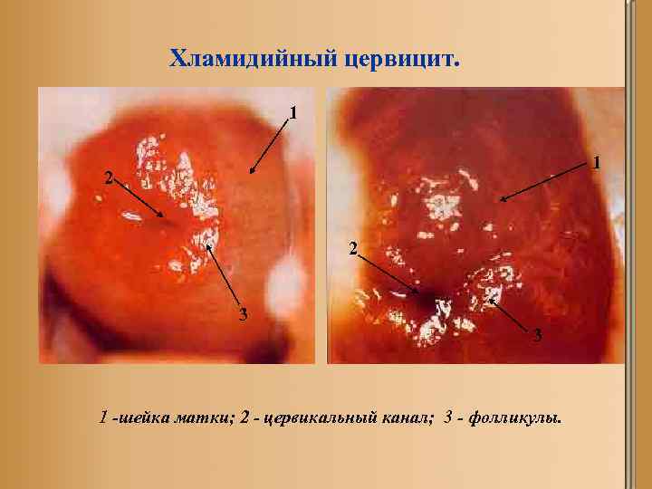 Хламидийный цервицит. 1 1 2 2 3 3 1 -шейка матки; 2 - цервикальный
