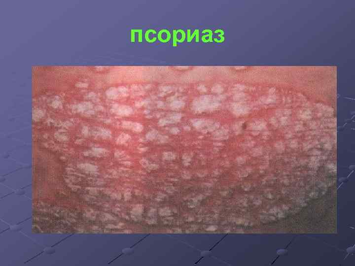 псориаз 