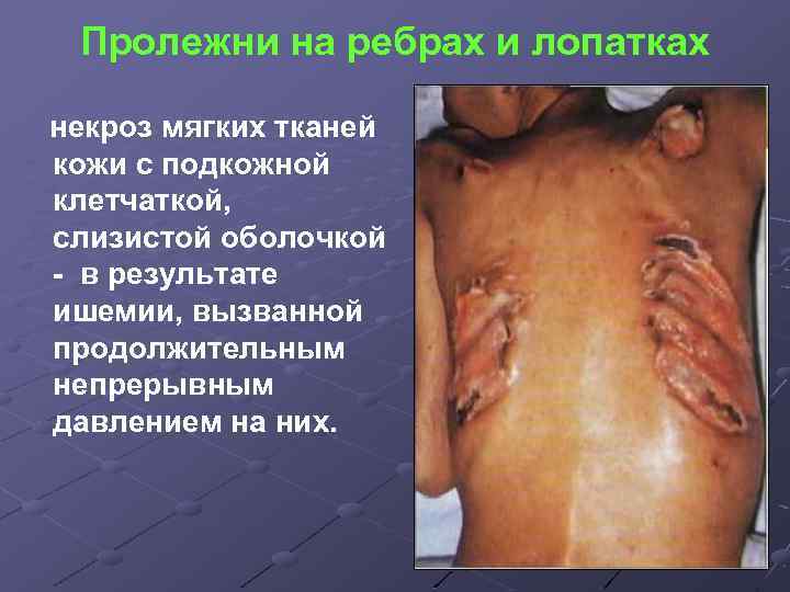 Пролежни на ребрах и лопатках некроз мягких тканей кожи с подкожной клетчаткой, слизистой оболочкой