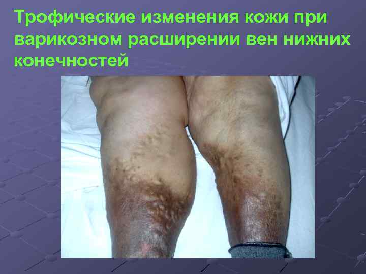 Трофические изменения кожи при варикозном расширении вен нижних конечностей 