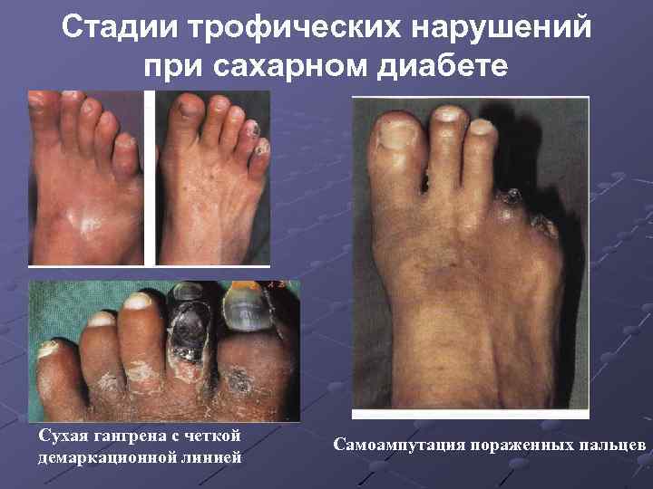 Стадии трофических нарушений при сахарном диабете Сухая гангрена с четкой демаркационной линией Самоампутация пораженных