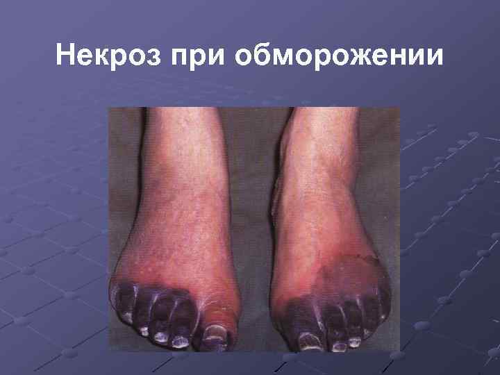 Некроз при обморожении 