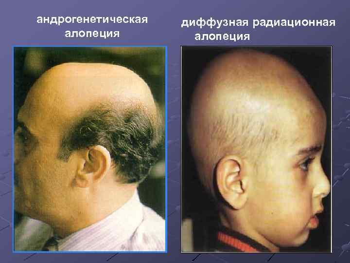 андрогенетическая алопеция диффузная радиационная алопеция 