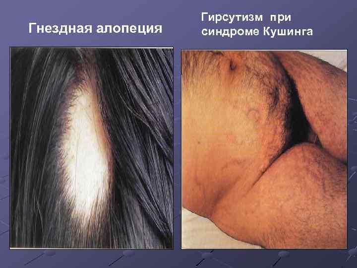 Гнездная алопеция Гирсутизм при синдроме Кушинга 