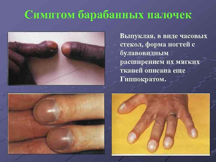 Симптом барабанных палочек Выпуклая, в виде часовых стекол, форма ногтей с булавовидным расширением их