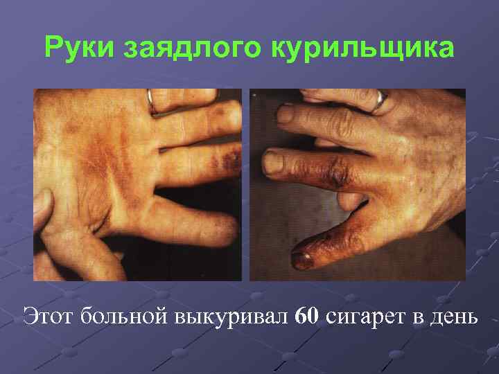 Руки заядлого курильщика Этот больной выкуривал 60 сигарет в день 